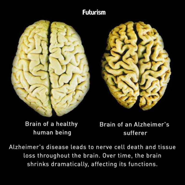 Diabetes Of The Brain: Are You At Risk?