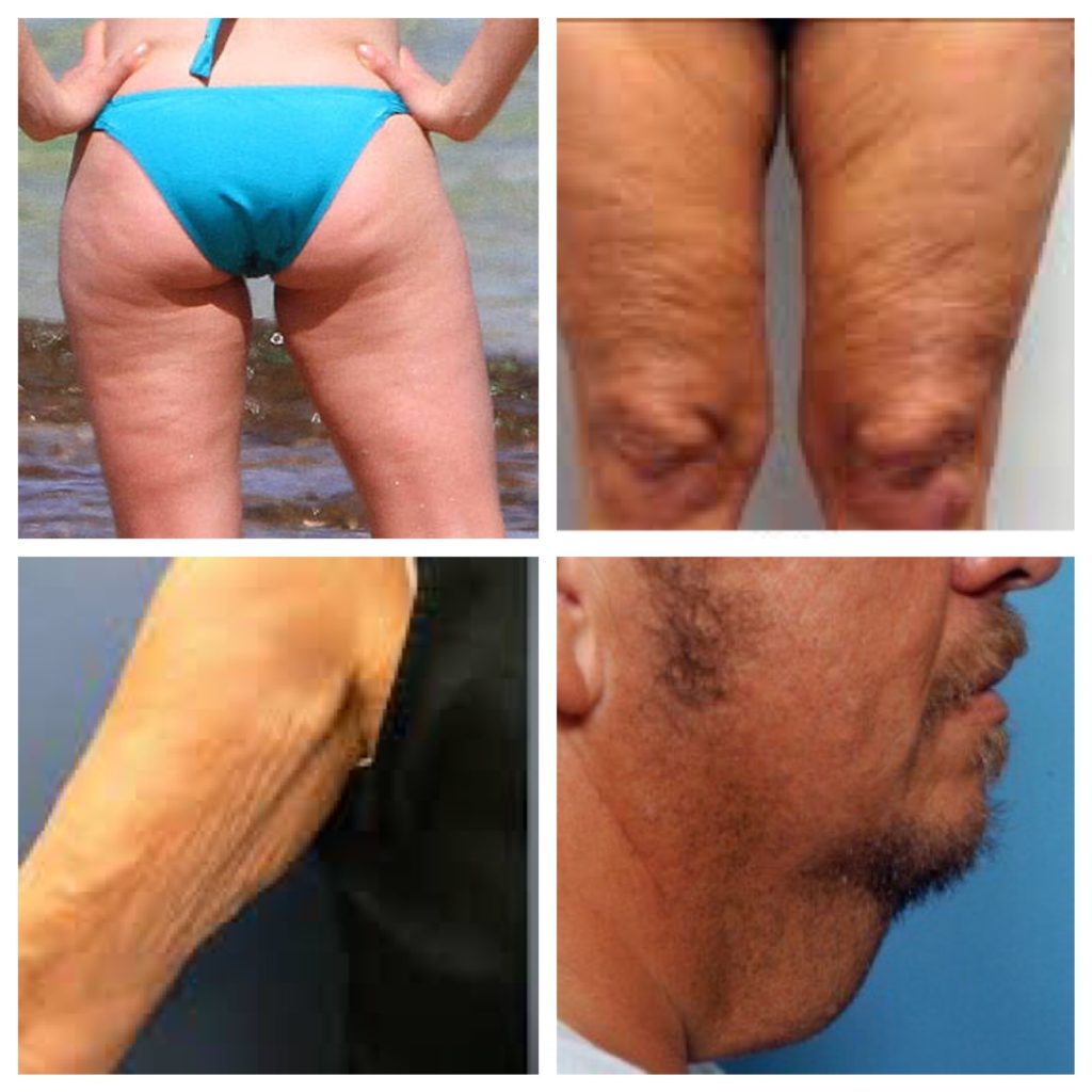 A collage of four images displaying areas with loose or sagging skin on the body, including the back of thighs, knees, underarm, and neck, with textures and folds visible in each area.
