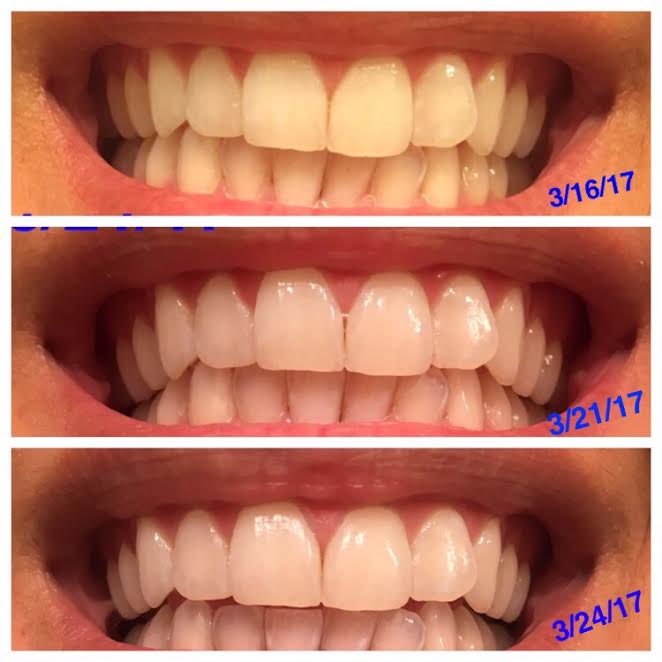 A three-panel close-up showing the progress of teeth whitening over time. The top image is labeled "3/16/17" with teeth that appear slightly yellow, the middle image labeled "3/21/17" shows brighter teeth, and the bottom image labeled "3/24/17" shows noticeably whiter teeth.