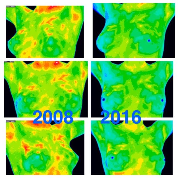 Thermography: Detecting breast cancer many years earlier than Mammography