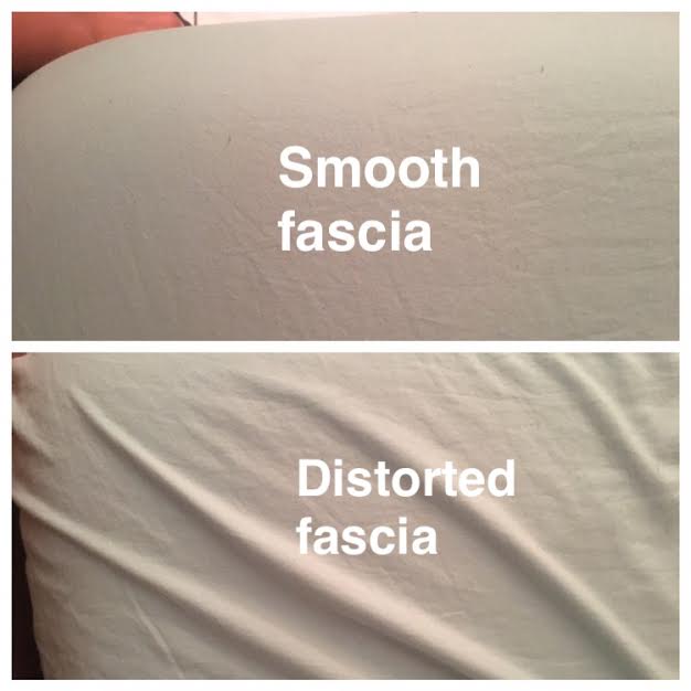 A comparison between smooth fascia and distorted fascia, showing a smooth surface at the top labeled "Smooth fascia" and a wrinkled surface at the bottom labeled Distorted fascia.