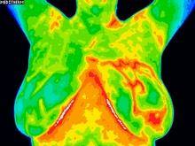 Inflammatory Breast cancer Thermography 3