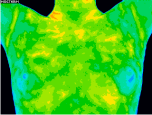 Thermography of breasts after use of frankincense oil. Reduced inflammation.