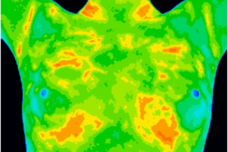 Thermography of breasts - 6/21/18 Pre rubbing frankincense oil on breasts.